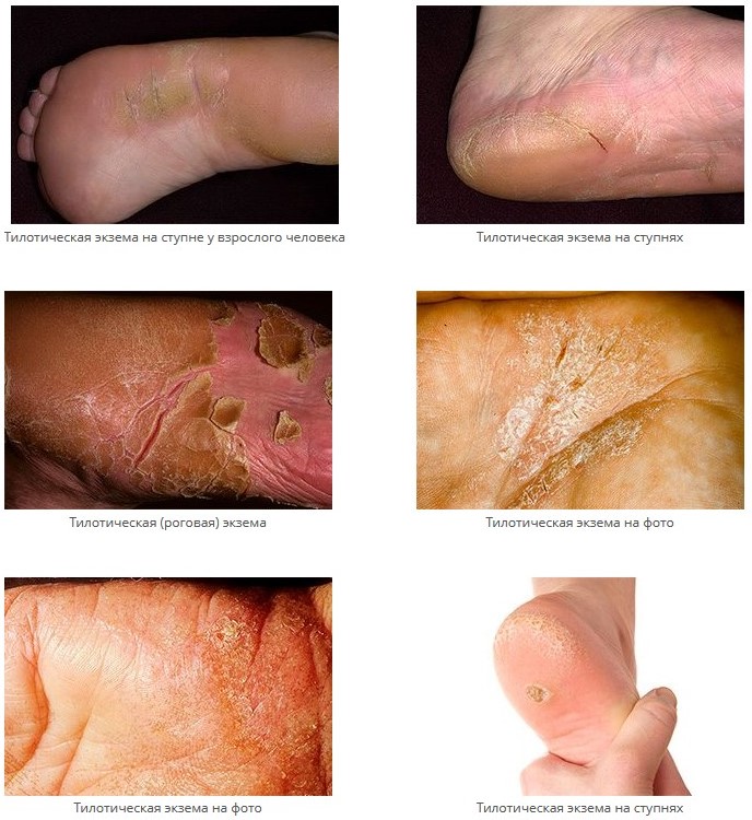 Стадии протекания и первые симптомы экземы на ногах